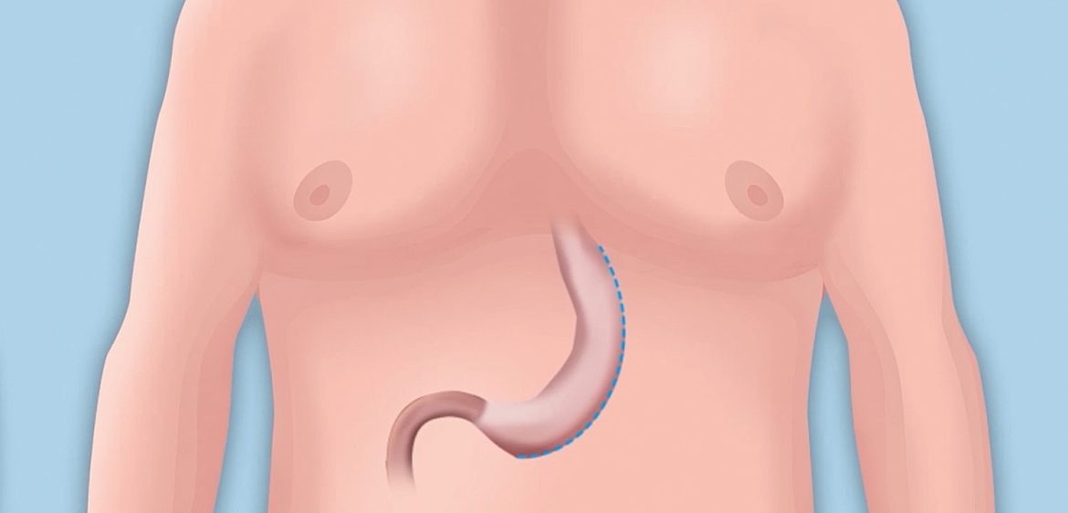 Professionelle Beratung und Betreuung bei Ihrer Magenverkleinerung Türkei